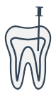 Diagram illustrating a root canal procedure